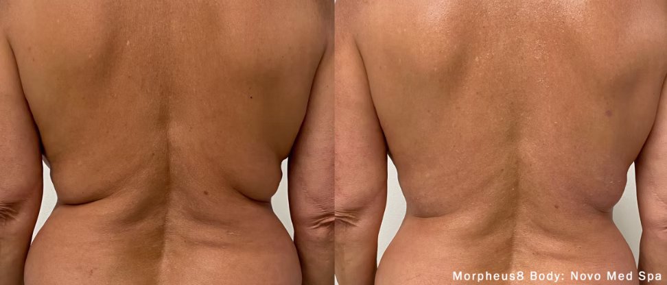 before and after back