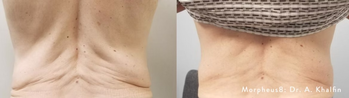 before and after back