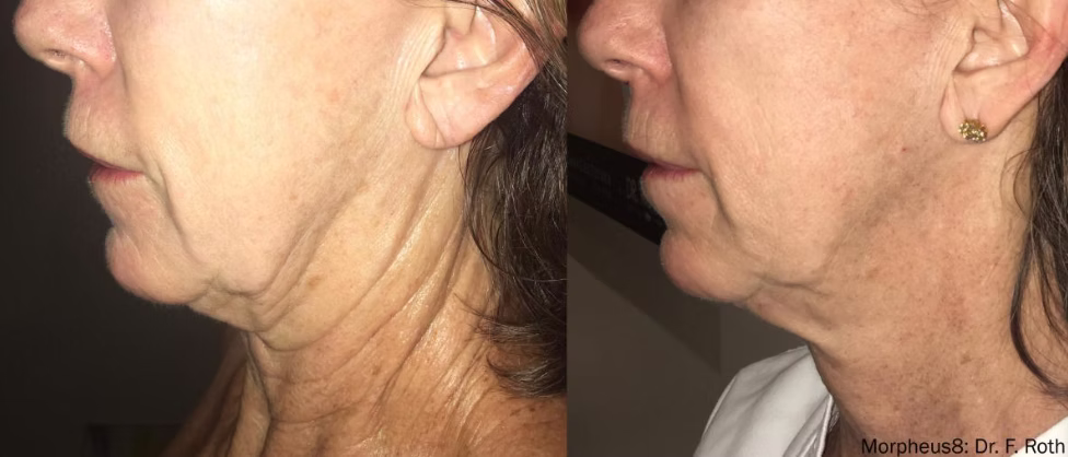 before and after neck