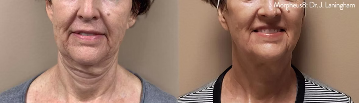 before and after neck