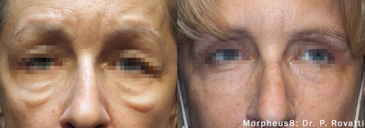 before and after under eye