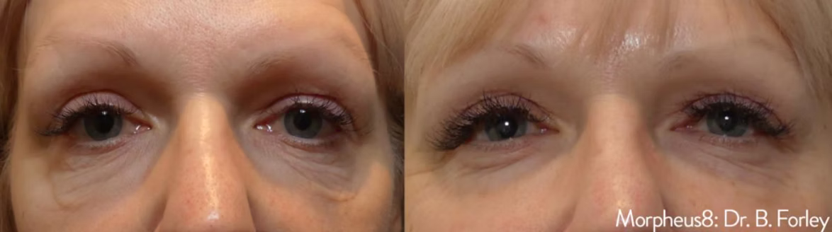 before and after undereye
